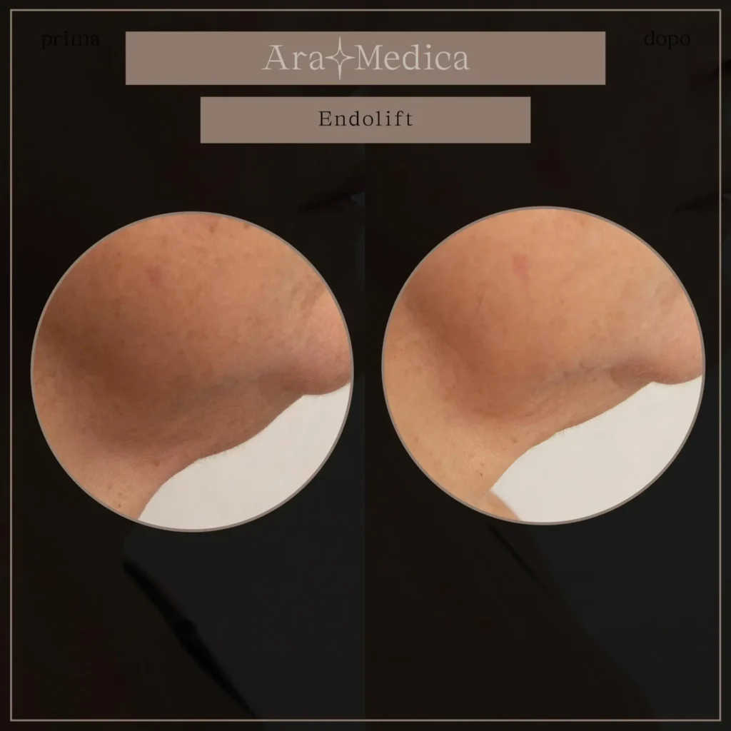 Endolift risultati