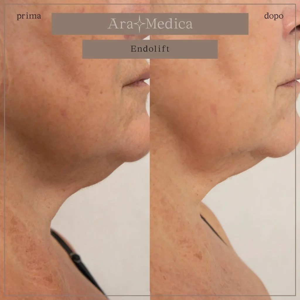 Endolift risultati2