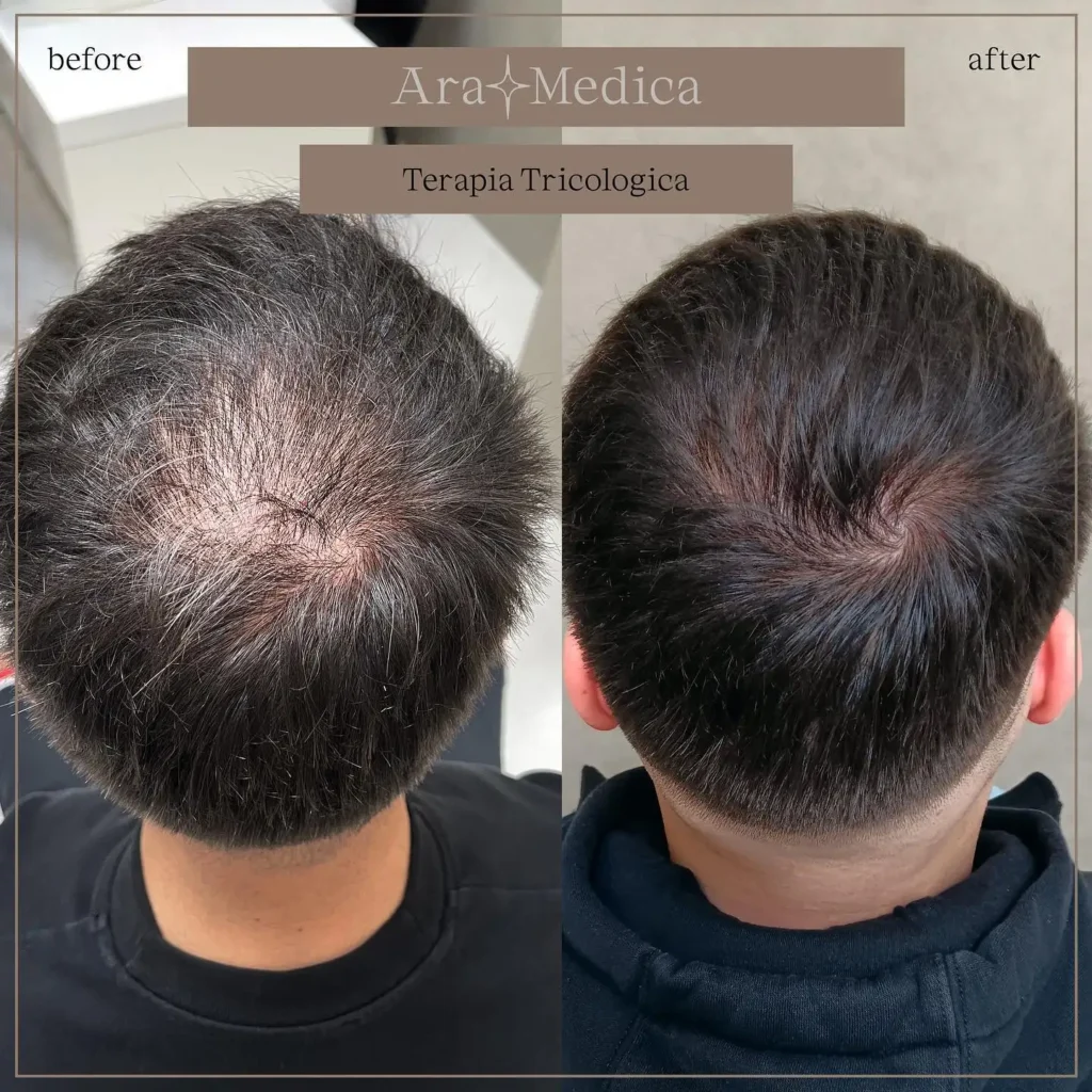 Terapia tricologica risultati