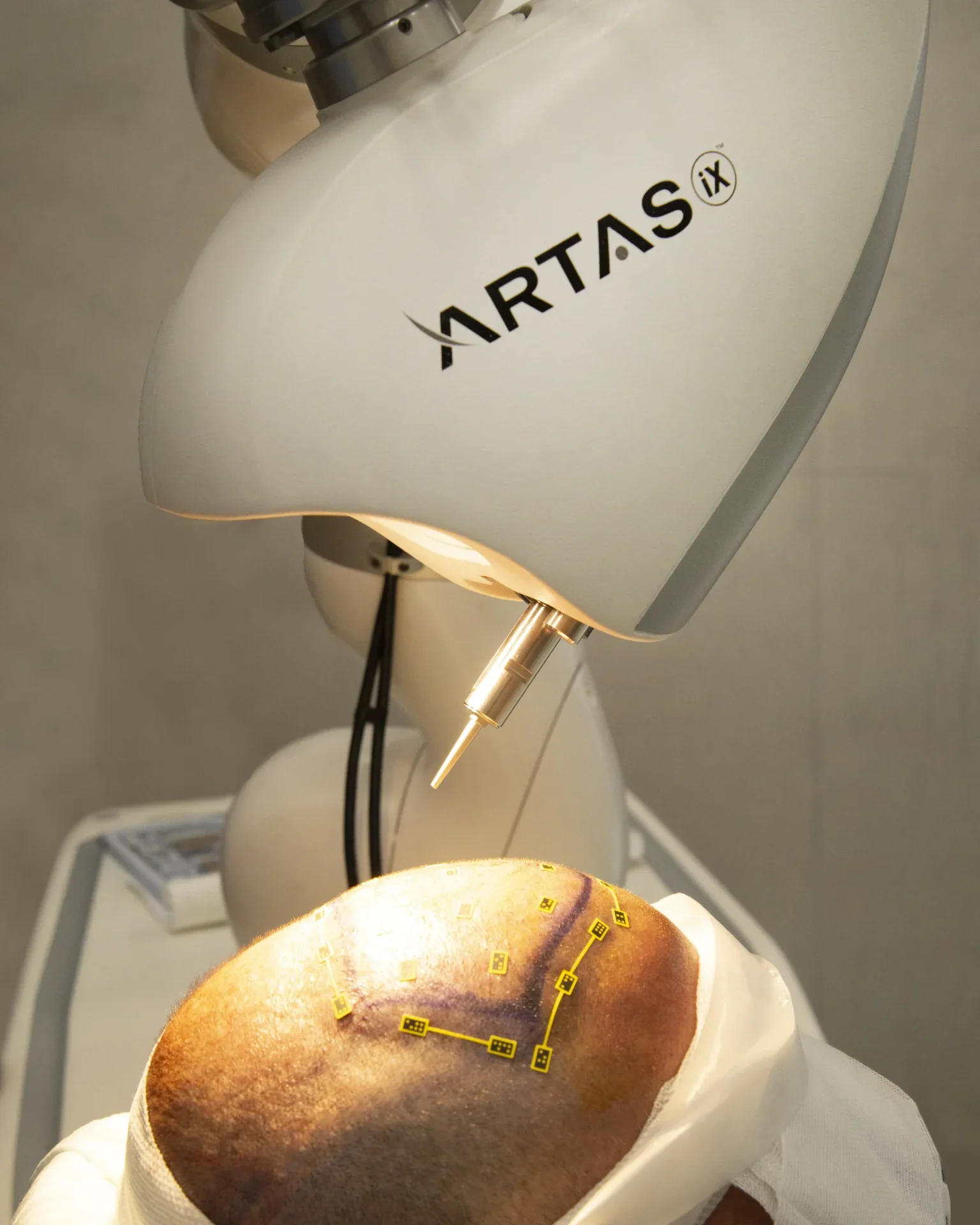 Artas trapianto capelli