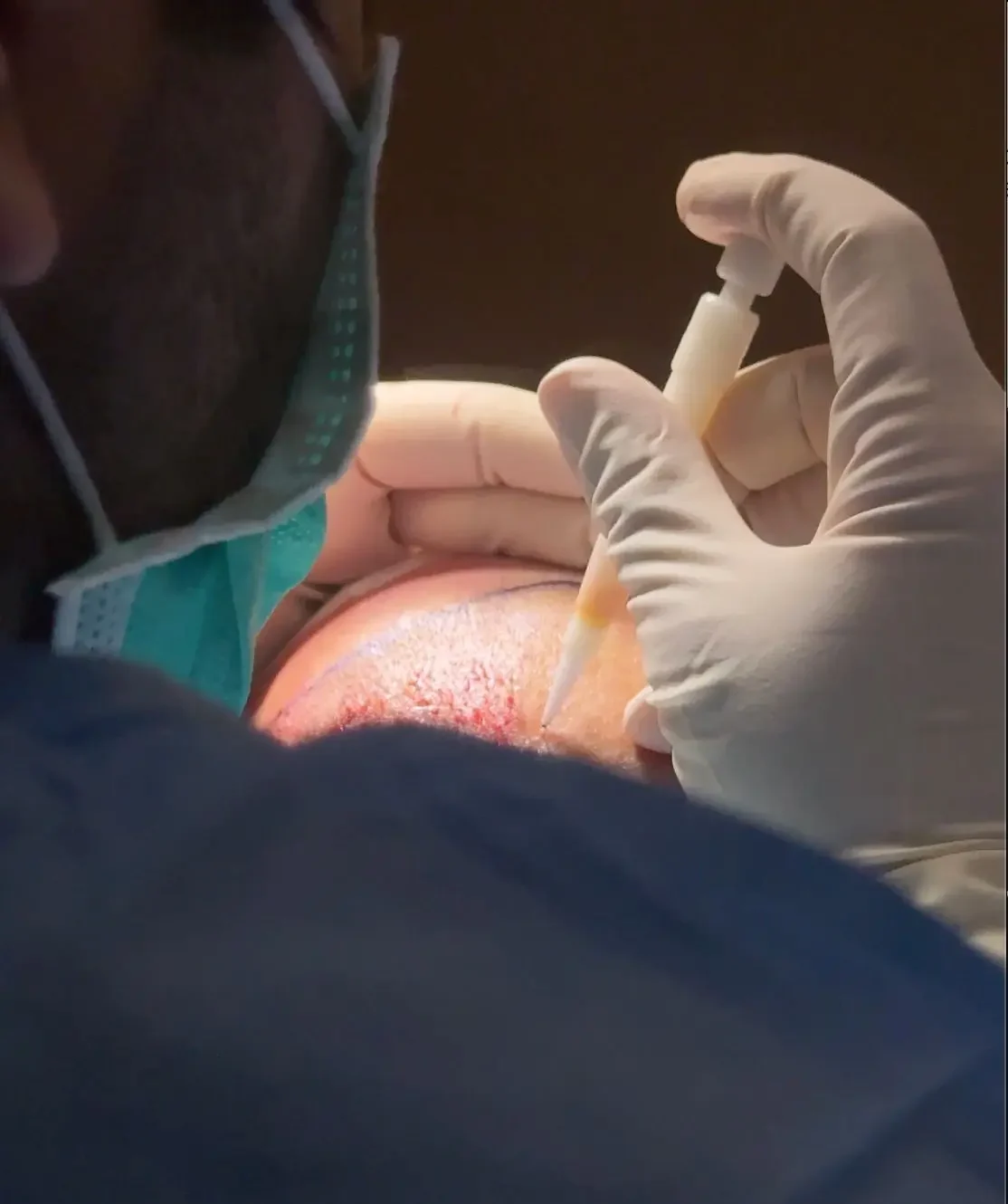 Tecnica dhi trapianto capelli