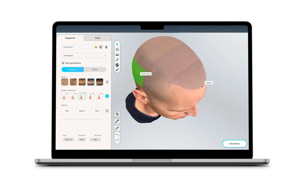 Force HT: simulazione 3D del trapianto di capelli su laptop e smartphone